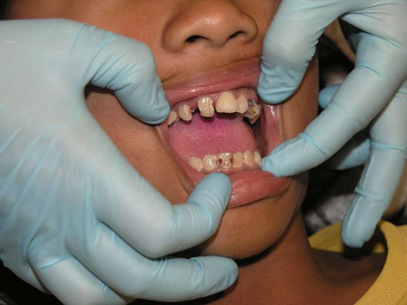 洗牙一个月后还是敏感的原因应该如何治疗